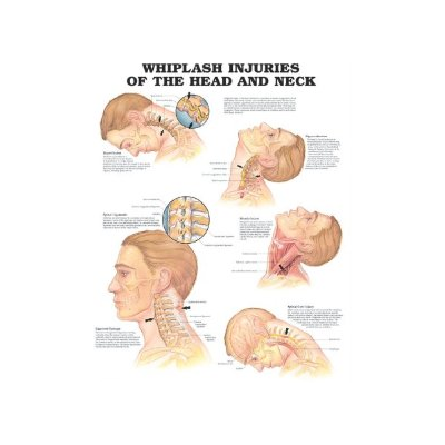 Whiplash Injuries of the Head and Neck Anatomical Chart