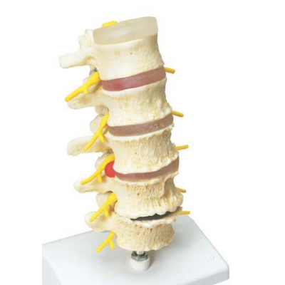 Stages of Disc Prolapse and Vertebral Degeneration