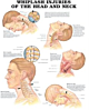 Whiplash Injuries of the Head and Neck Anatomical Chart